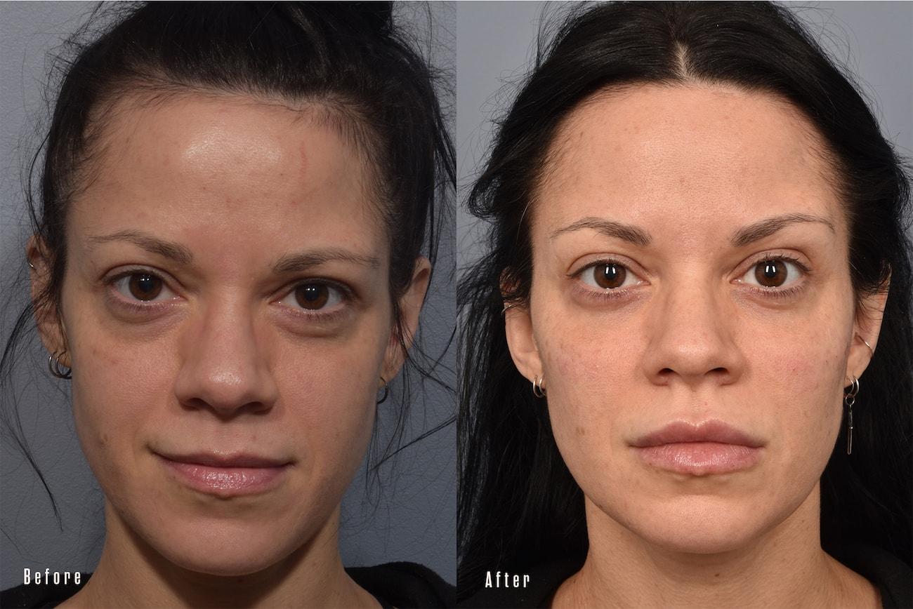 Pearlman Aesthetic Surgery eyelid lift result — New York, NY