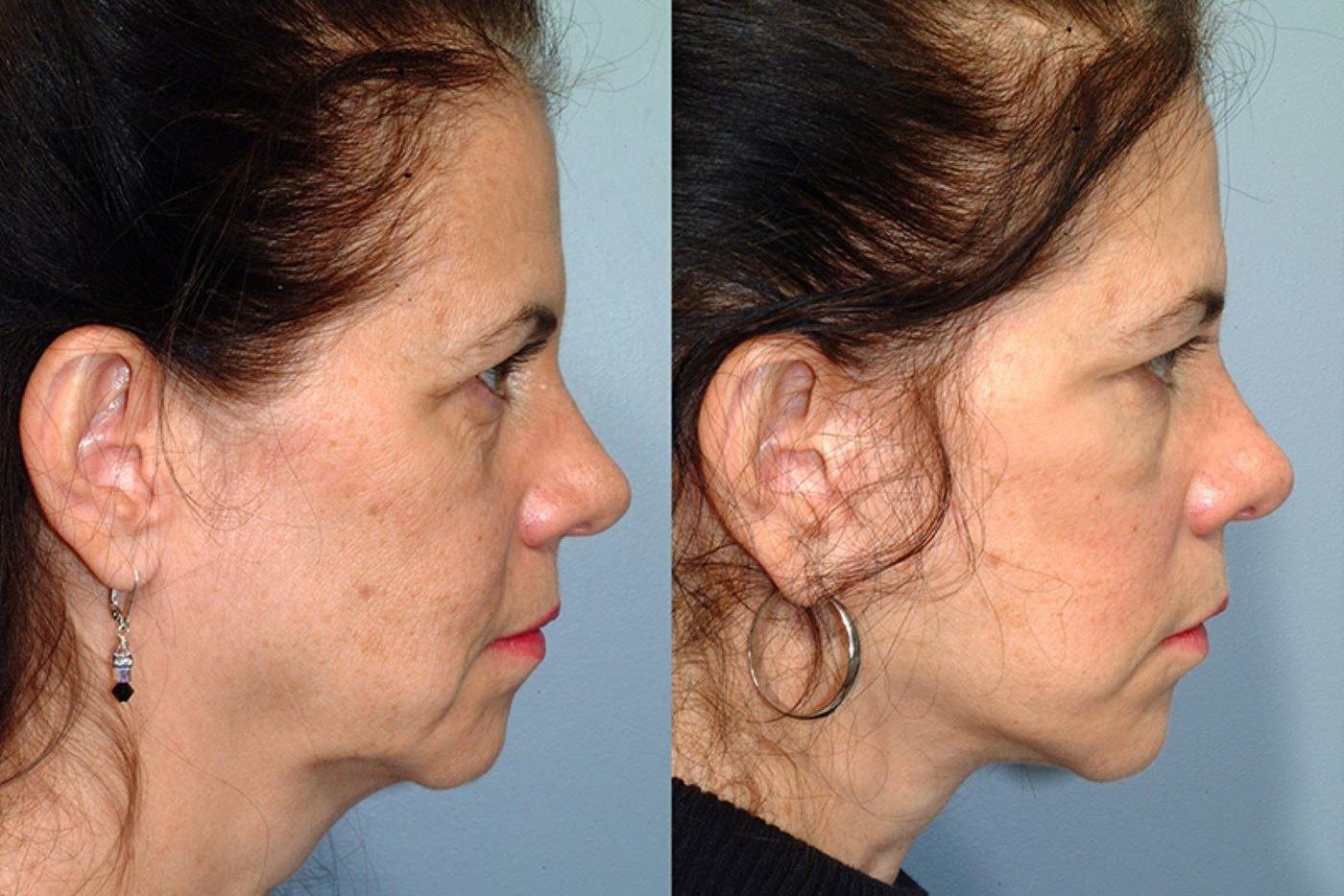 Pearlman Aesthetic Surgery facelift result — New York, NY