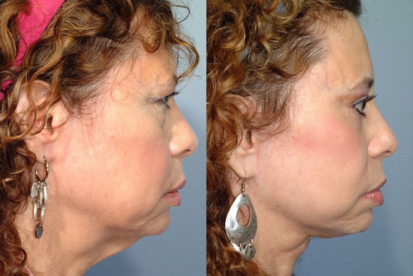 Pearlman Aesthetic Surgery facelift result — New York, NY
