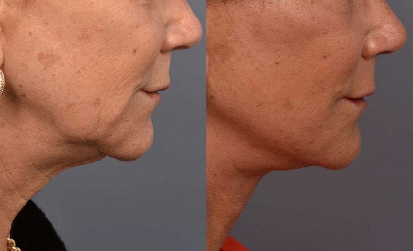 Pearlman Aesthetic Surgery facelift result — New York, NY