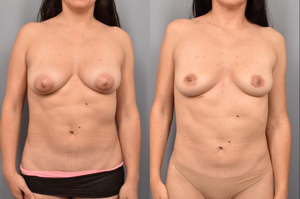 Pearlman Aesthetic Surgery breast lift result — New York, NY