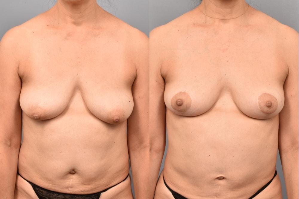 Pearlman Aesthetic Surgery breast lift result — New York, NY
