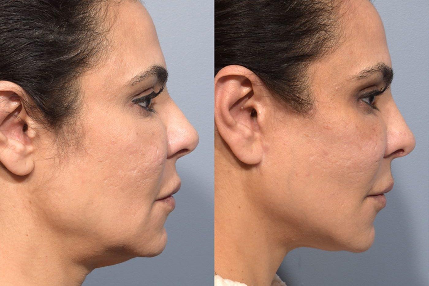 Pearlman Aesthetic Surgery facelift result — New York, NY