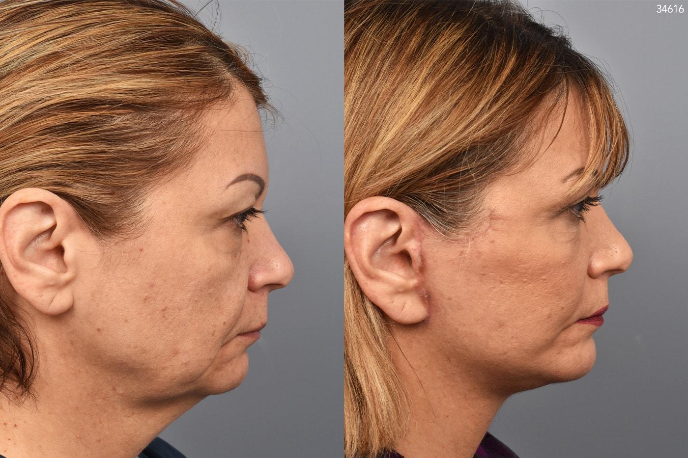 Pearlman Aesthetic Surgery facelift result — New York, NY