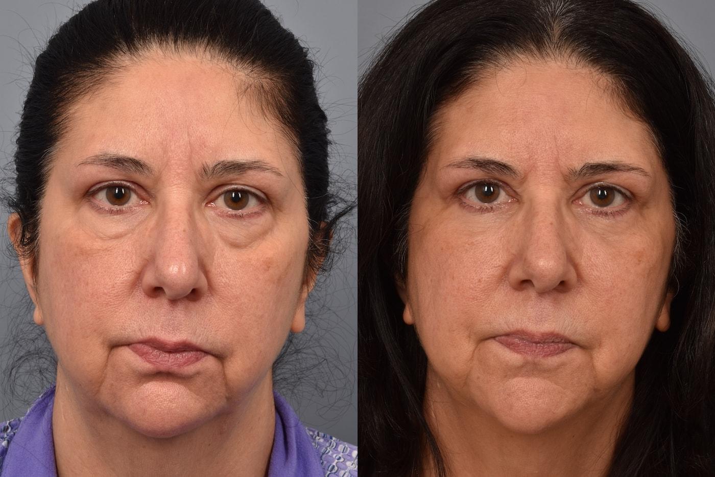 Pearlman Aesthetic Surgery eyelid lift result — New York, NY
