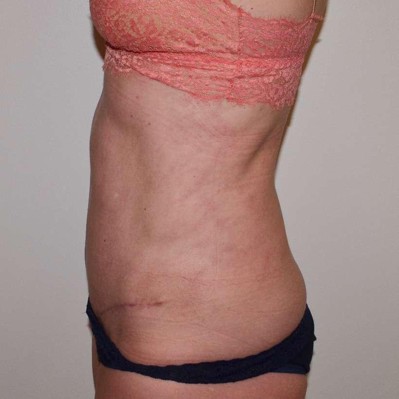 360 Plastic Surgery tummy tuck after — Austin, TX