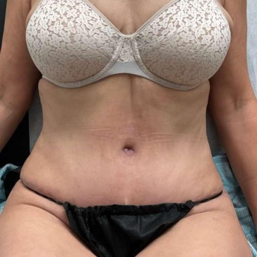 360 Plastic Surgery tummy tuck after — Austin, TX