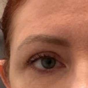 360 Plastic Surgery blepharoplasty after — Austin, TX