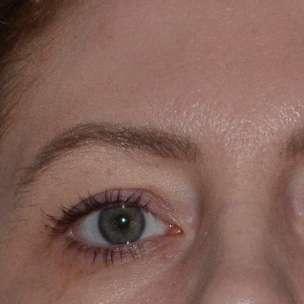 Blepharoplasty before at 360 Plastic Surgery in Austin, TX