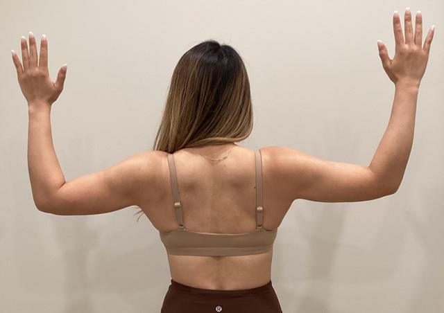 Liposuction after at 360 Plastic Surgery in Austin, TX