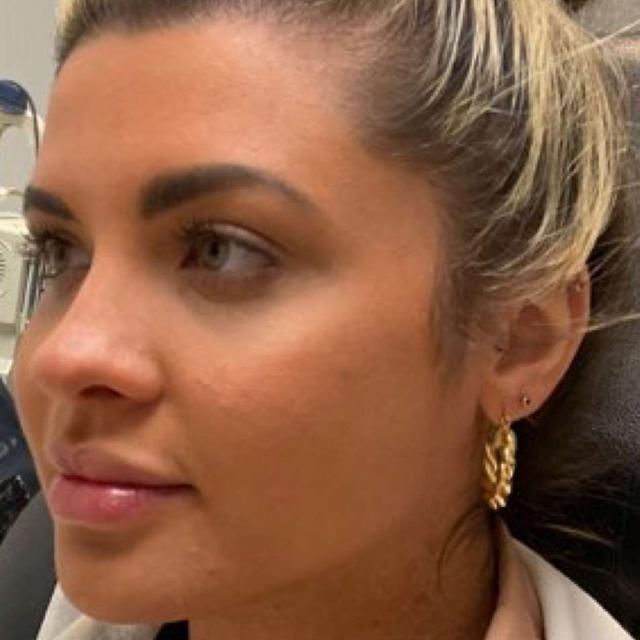 Liquid Rhinoplasty before at 360 Plastic Surgery in Austin, TX