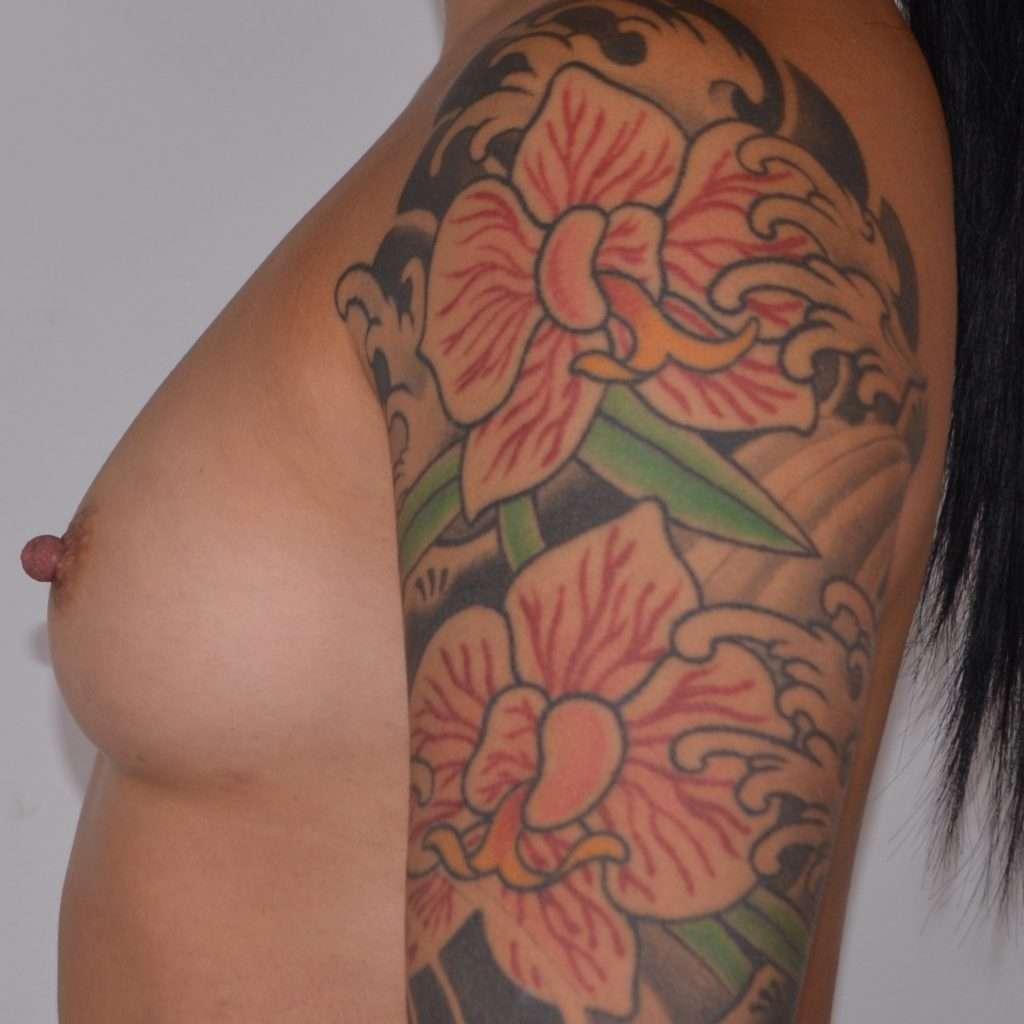 360 Plastic Surgery fat transfer after — Austin, TX