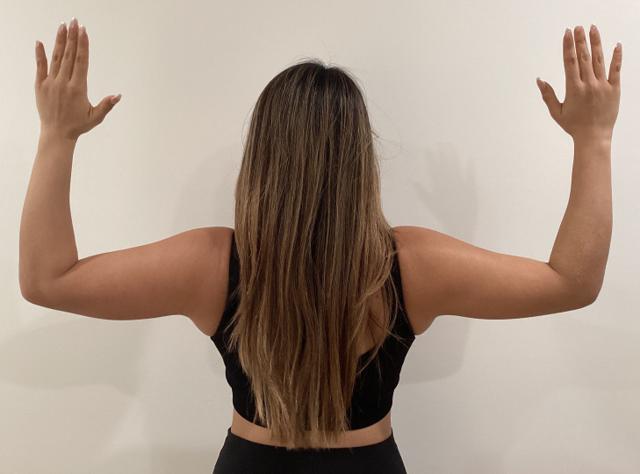 Liposuction before at 360 Plastic Surgery in Austin, TX