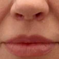 360 Plastic Surgery lip lift after — Austin, TX