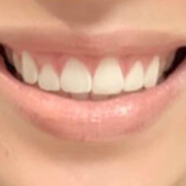 360 Plastic Surgery botox after — Austin, TX