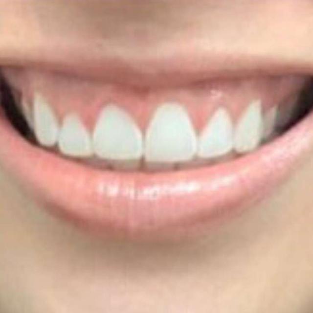 Botox before at 360 Plastic Surgery in Austin, TX