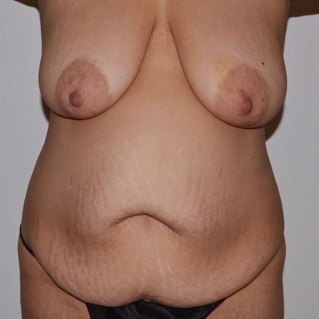 Mommy Makeover before at 360 Plastic Surgery in Austin, TX