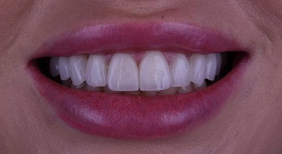 Carlsbad Beach Dental - Drew Addy, DDS smile makeover after — Carlsbad, CA