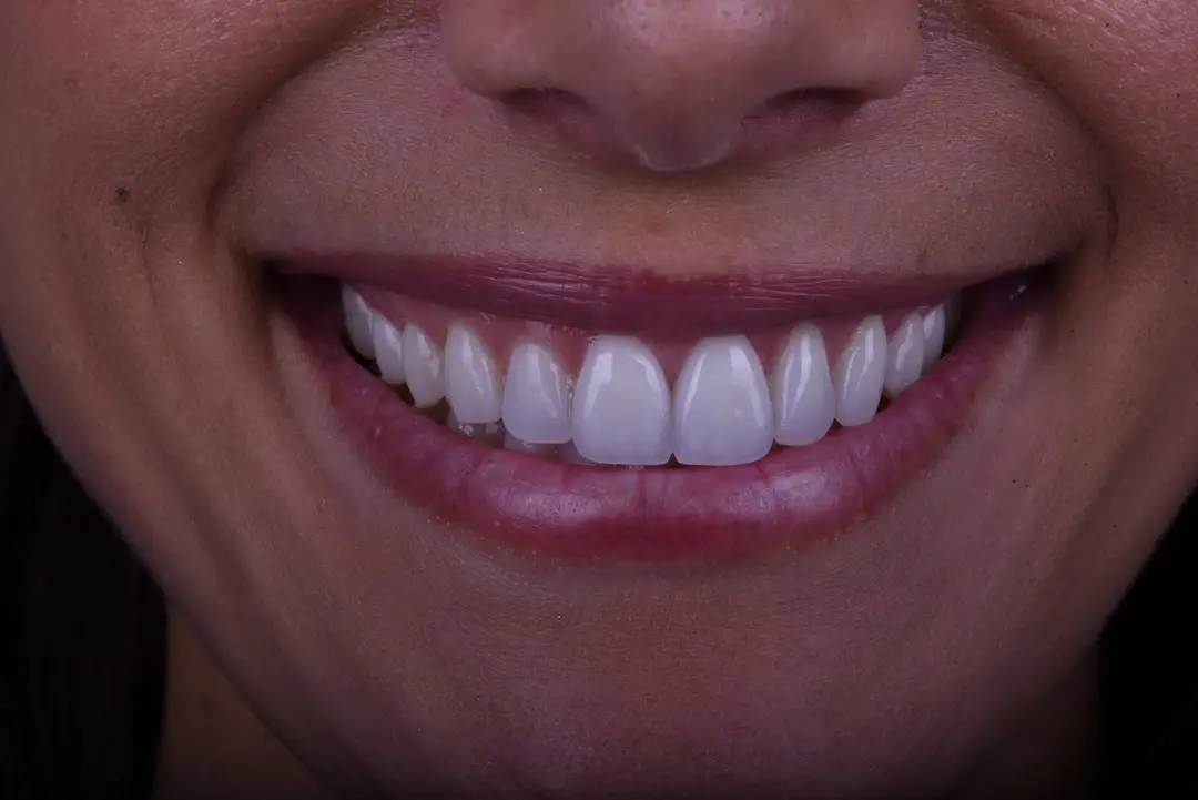 Carlsbad Beach Dental - Drew Addy, DDS veneers after — Carlsbad, CA