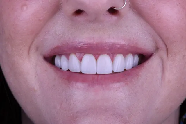 Teeth Whitening after at Carlsbad Beach Dental - Drew Addy, DDS in Carlsbad, CA