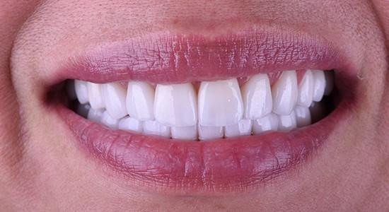 Carlsbad Beach Dental - Drew Addy, DDS smile makeover after — Carlsbad, CA