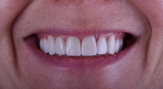 Carlsbad Beach Dental - Drew Addy, DDS smile makeover after — Carlsbad, CA