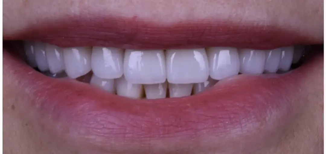 Carlsbad Beach Dental - Drew Addy, DDS veneers after — Carlsbad, CA