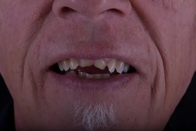Smile Makeover before at Carlsbad Beach Dental - Drew Addy, DDS in Carlsbad, CA