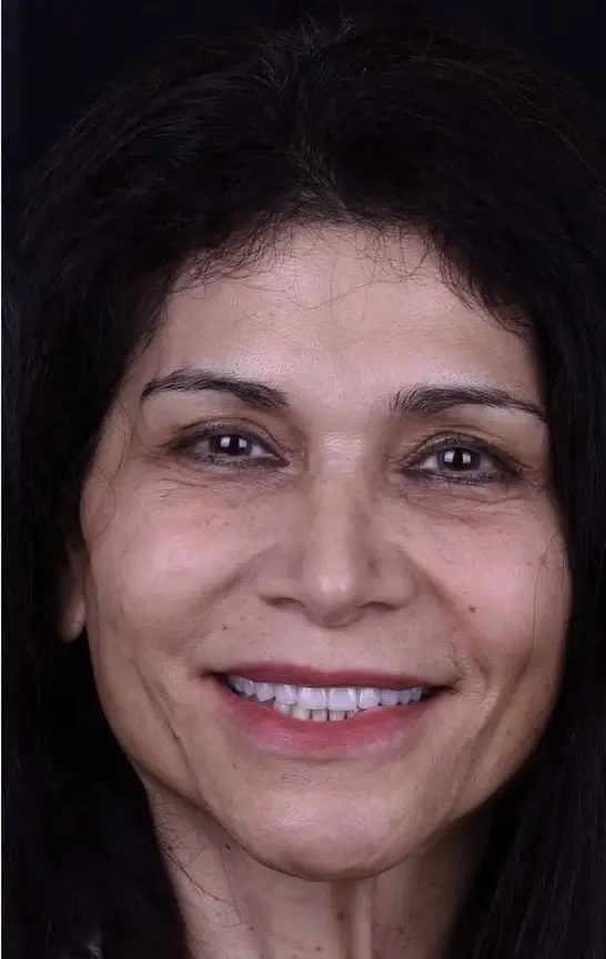 Carlsbad Beach Dental - Drew Addy, DDS veneers after — Carlsbad, CA