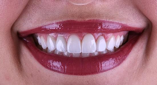 Carlsbad Beach Dental - Drew Addy, DDS smile makeover after — Carlsbad, CA