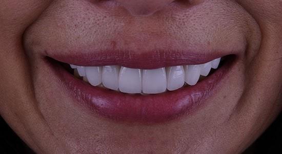 Carlsbad Beach Dental - Drew Addy, DDS veneers after — Carlsbad, CA