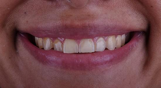 Smile Makeover before at Carlsbad Beach Dental - Drew Addy, DDS in Carlsbad, CA