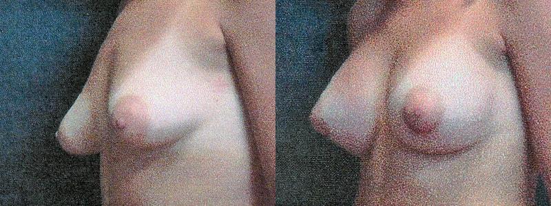 Erwin S Wheeler, MD breast augmentation result — La Mesa, CA