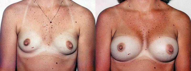 Erwin S Wheeler, MD breast augmentation result — La Mesa, CA