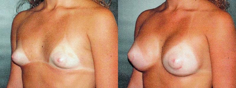 Erwin S Wheeler, MD breast augmentation result — La Mesa, CA