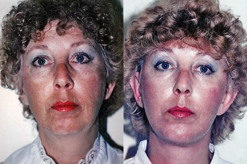 Erwin S Wheeler, MD facelift result — La Mesa, CA