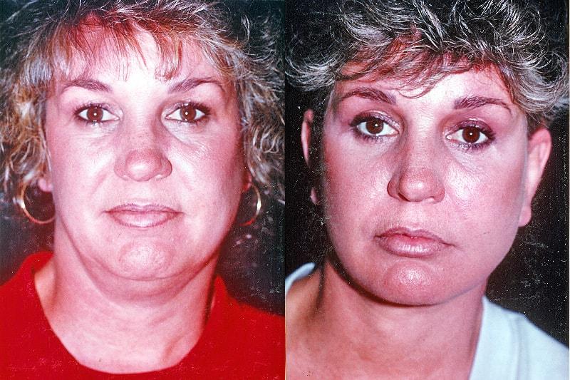 Erwin S Wheeler, MD facelift result — La Mesa, CA