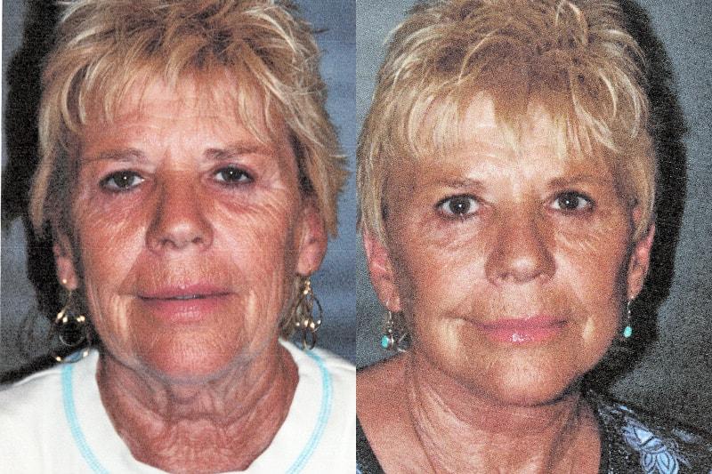 Erwin S Wheeler, MD facelift result — La Mesa, CA