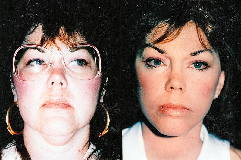 Erwin S Wheeler, MD facelift result — La Mesa, CA