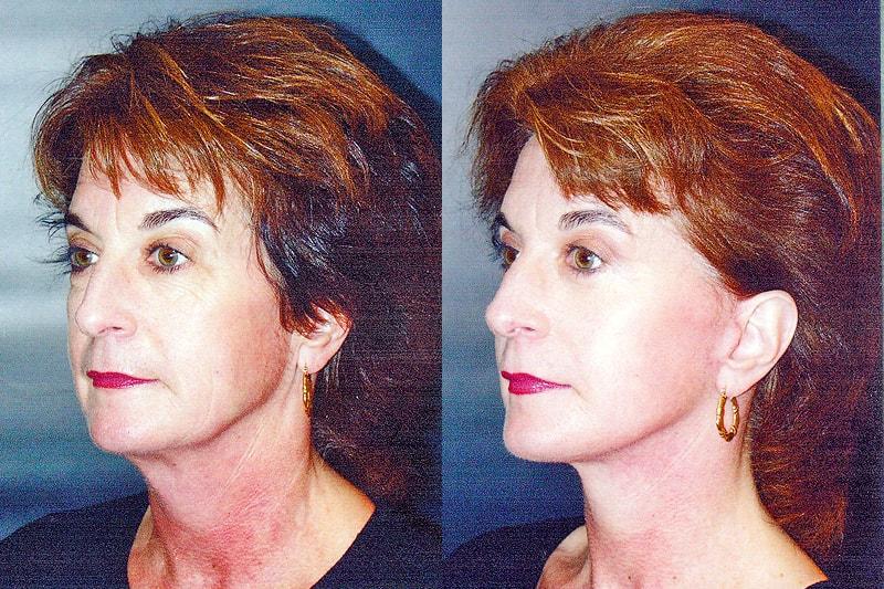 Erwin S Wheeler, MD facelift result — La Mesa, CA