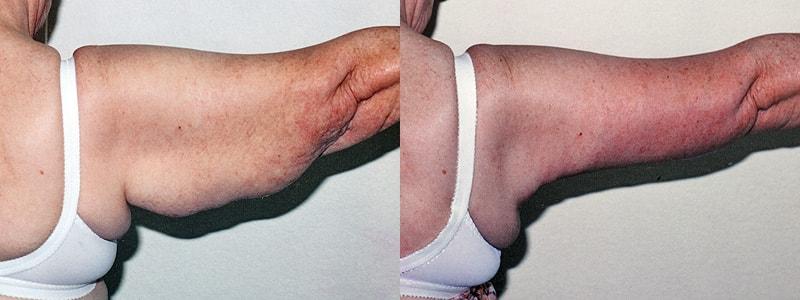 Erwin S Wheeler, MD arm lift result — La Mesa, CA