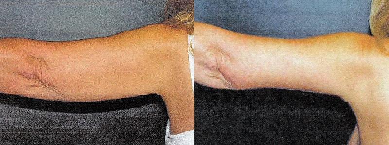 Erwin S Wheeler, MD arm lift result — La Mesa, CA