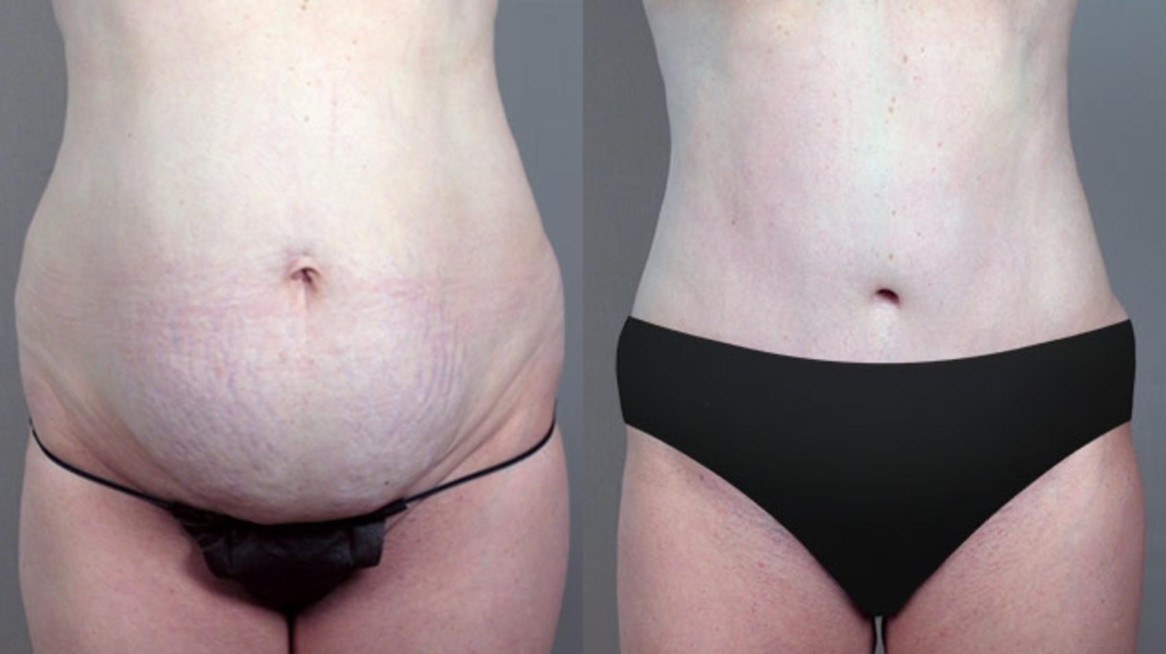Parker Center for Plastic Surgery tummy tuck result — Paramus, NJ