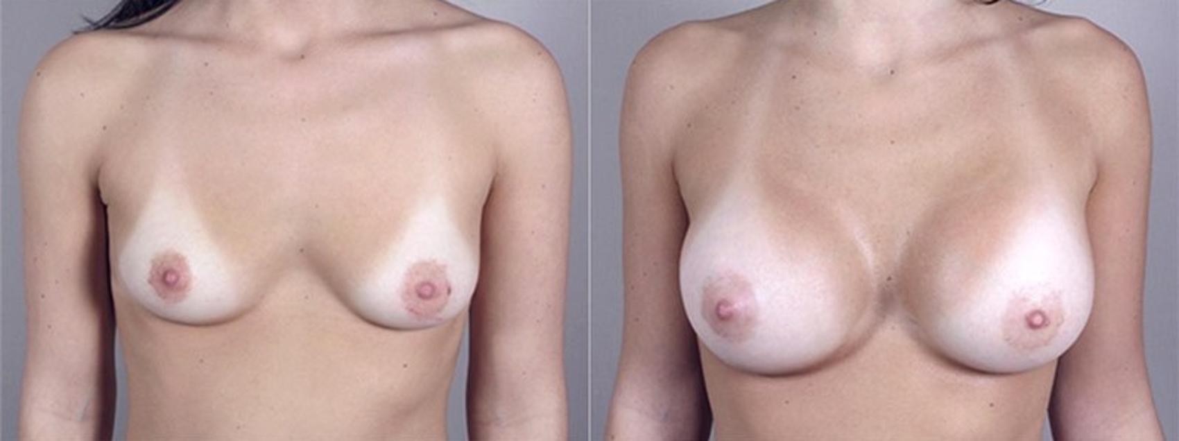Parker Center for Plastic Surgery breast augmentation result — Paramus, NJ
