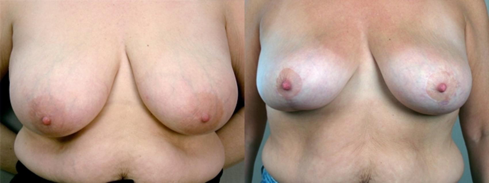 Parker Center for Plastic Surgery breast lift result — Paramus, NJ