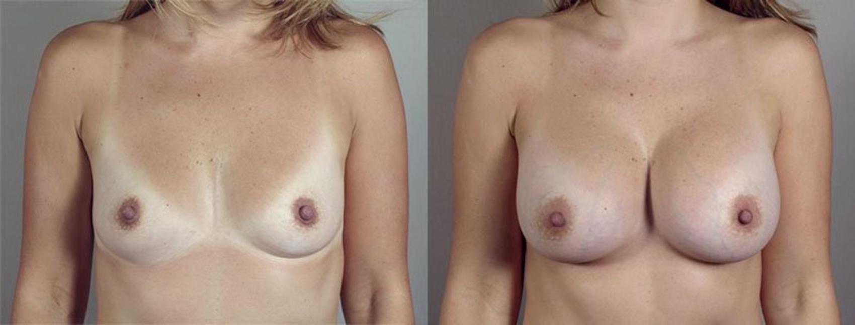 Parker Center for Plastic Surgery breast augmentation result — Paramus, NJ