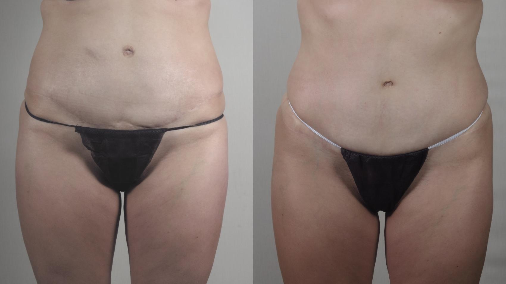 Parker Center for Plastic Surgery tummy tuck result — Paramus, NJ