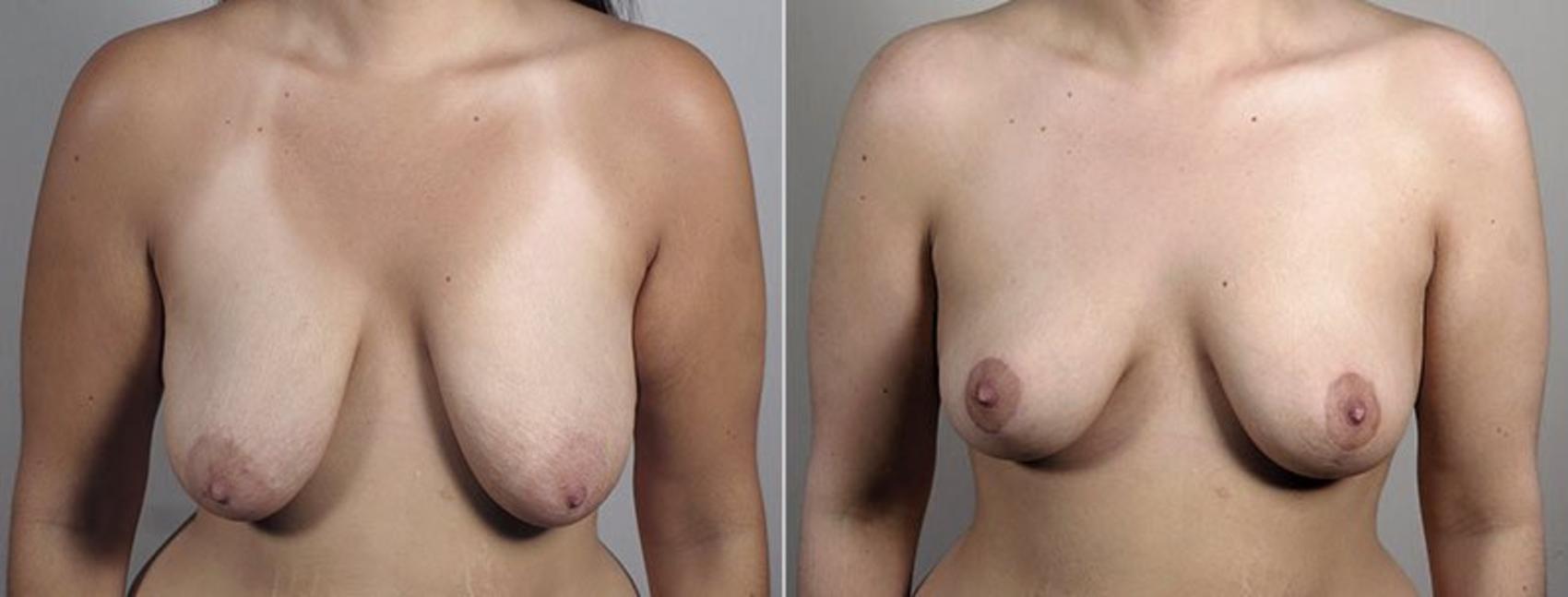 Parker Center for Plastic Surgery breast lift result — Paramus, NJ