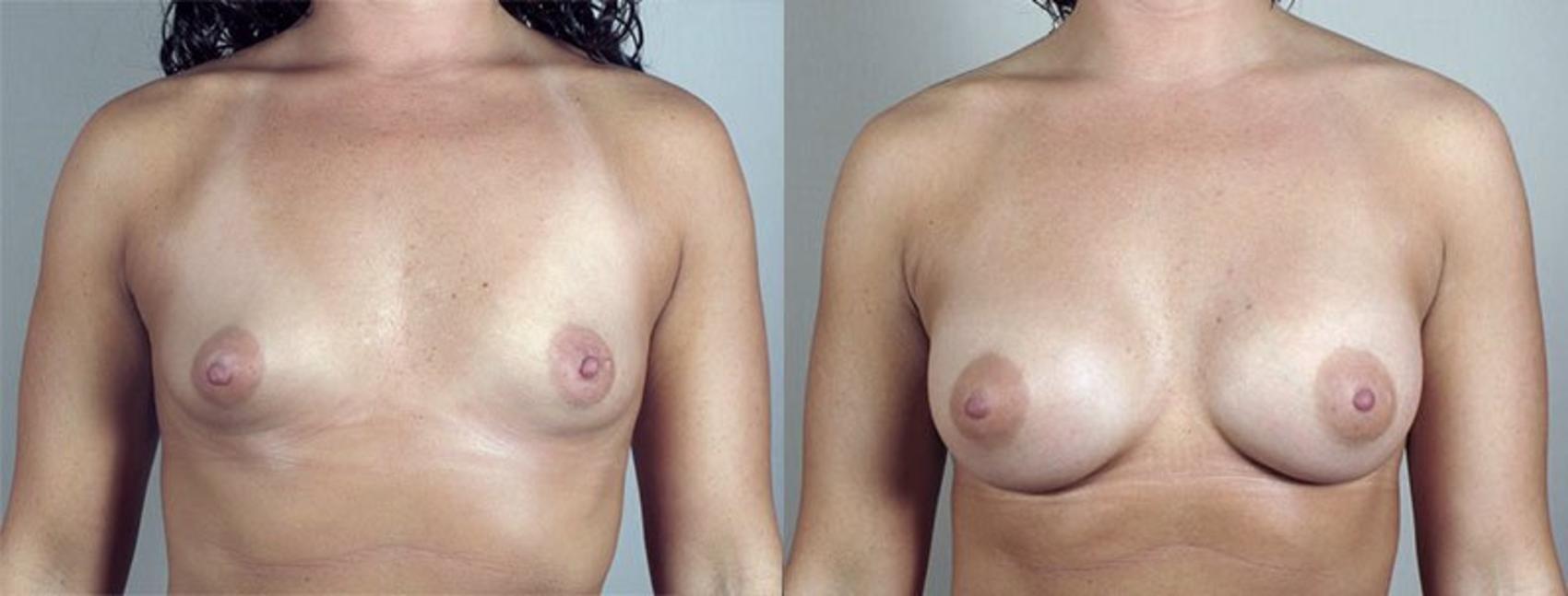 Parker Center for Plastic Surgery breast augmentation result — Paramus, NJ
