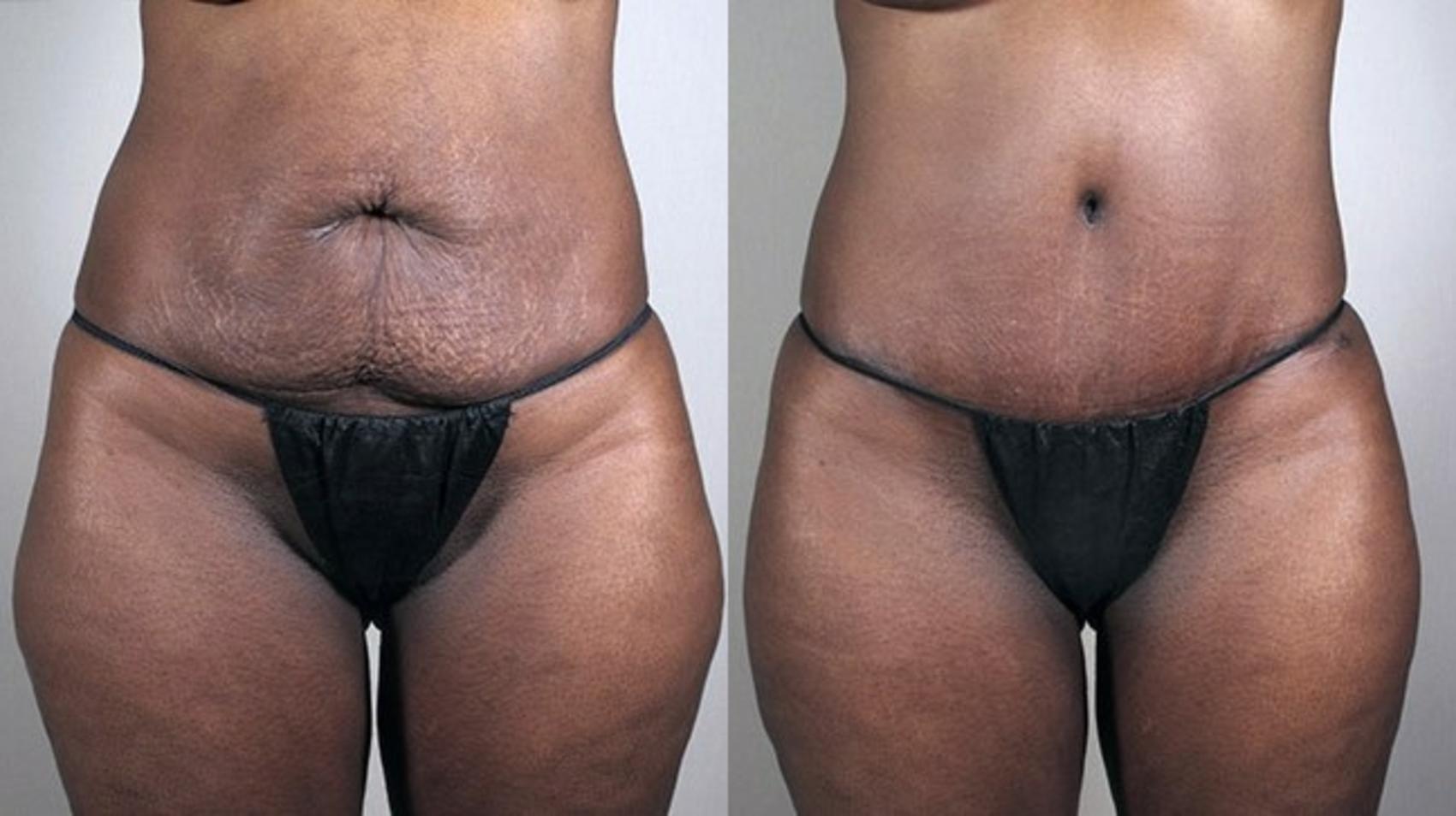 Parker Center for Plastic Surgery tummy tuck result — Paramus, NJ
